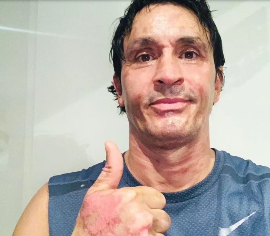 Sebastián Estevanez mostró por primera vez su rostro luego de sufrir quemaduras